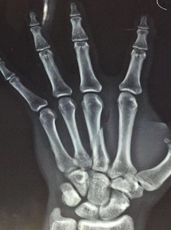 Hasil rontgen jari tangan kanan Gerry Salim
